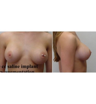 Breast Implants & Body Piercing After